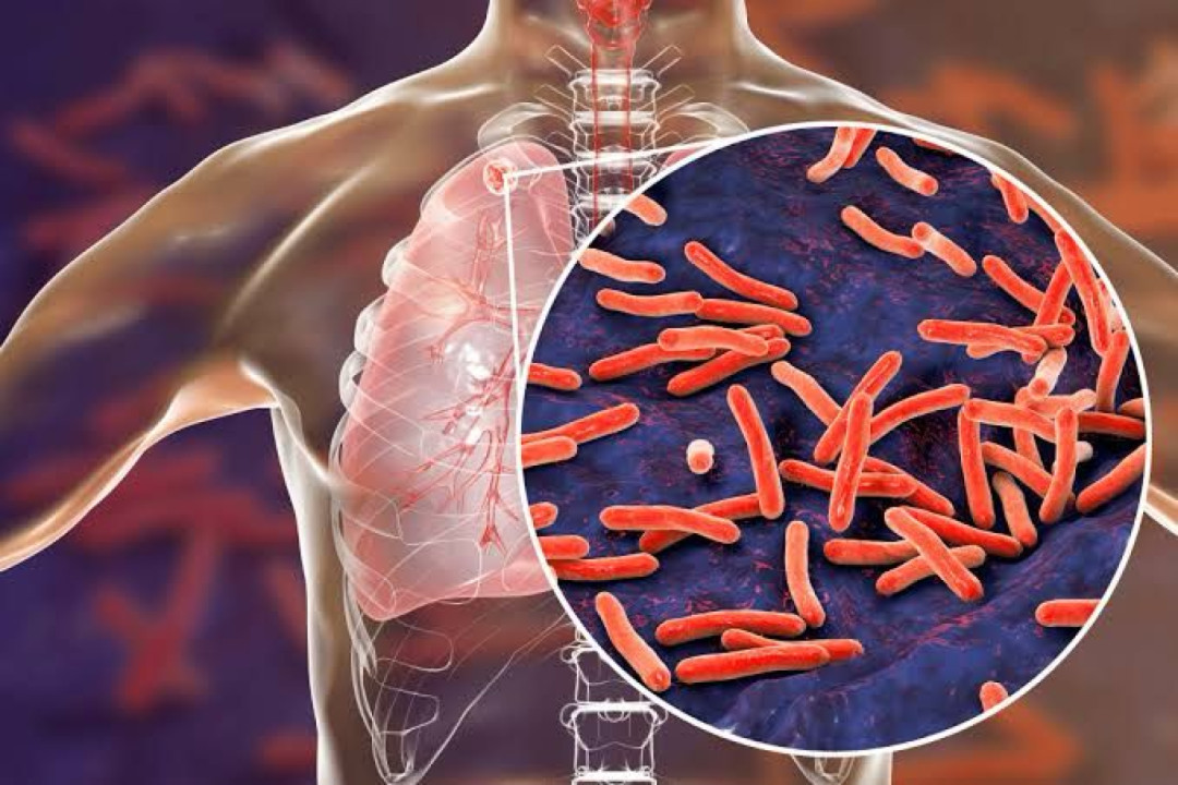 Dinkes Kepri: Dari Hasil Skrining 24 Ribu Lebih Warga Positif Tuberkulosis
